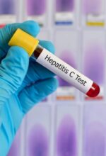 هپاتیت C چطور تشخیص داده می‌شود؟